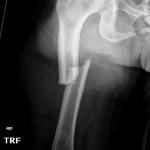 Atypical femur fracture X-ray