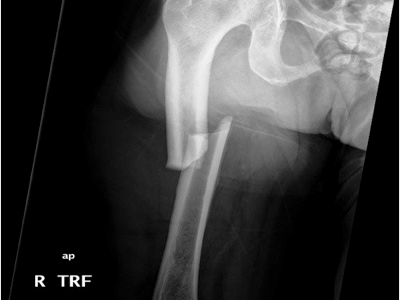 Atypical femur fracture X-ray