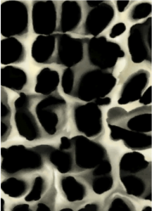 Osteoporosis Microstructure