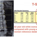 T-score DXA lumbar spine scan Hologic