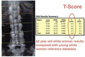 T-score DXA lumbar spine scan Hologic