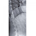 Vertebral Fracture Assessment Hologic image