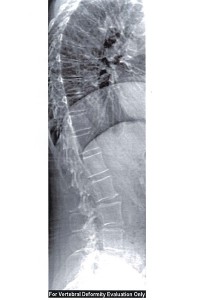 Vertebral Fracture Assessment Hologic image