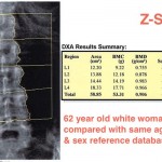 Z-score DXA lumbar spine scan Hologic