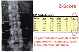 Z-score DXA lumbar spine scan Hologic