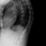 kyphosis by x-ray