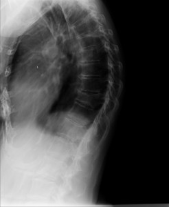 kyphosis by x-ray